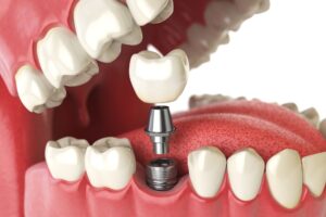Top 8 Benefits of Getting Dental Implants