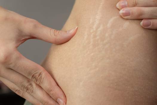 What Are The Types Of Stretch Marks And How To Get Rid Of Them?